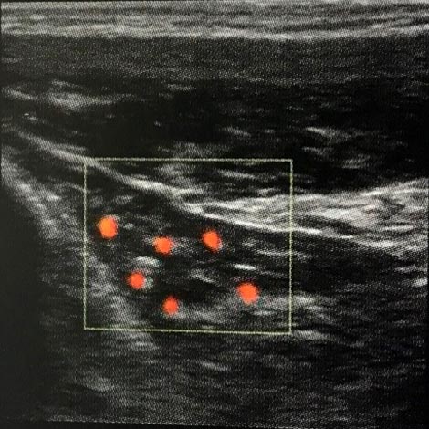 PDI Aufnahme: Epicondylitis lateralis, Neovaskularisation in der Sehne des M.extensor carpi radialis brevis.