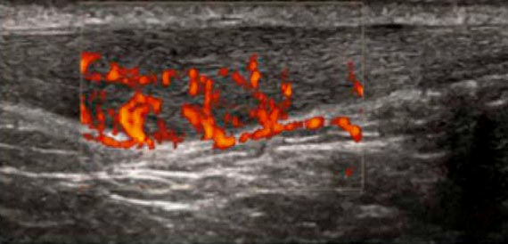 PDI Aufnahme: Irreguläre Gefäßbildung in der Achillessehe (Neovaskularisation) bei Achillodynie (Entzündung der Achillessehne).